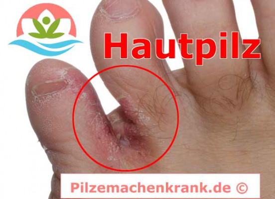 Hautpilz erkennen und behandeln Mittel zur Mykose Behandlung Hautpilz Bilder Aussehen Mykosis