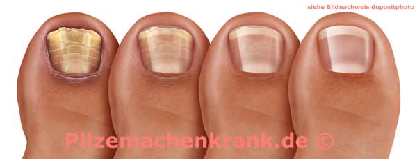 Nagelpilz behandeln Behandlung von Pilzen am Nagel Bilder